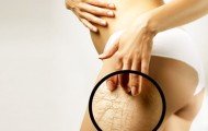 Как избавиться от растяжек?
