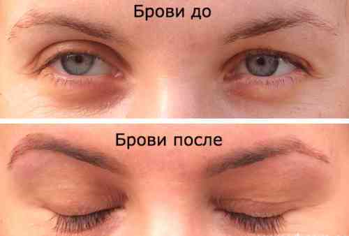 фото до и после использования касторки